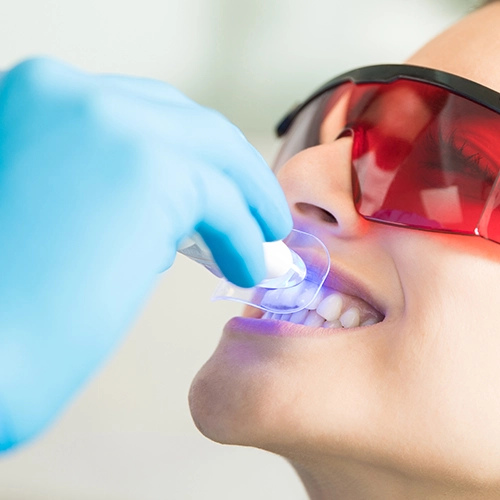 carillas y blanqueamiento dental