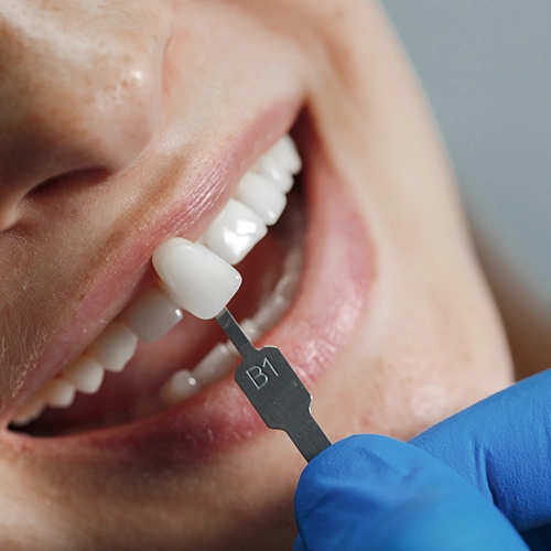 implantes dentales en Murcia
