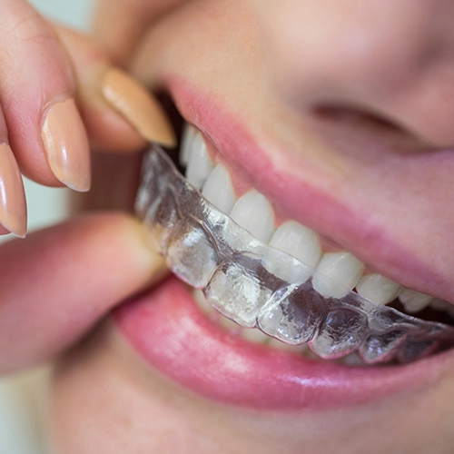 funda invisible para dientes