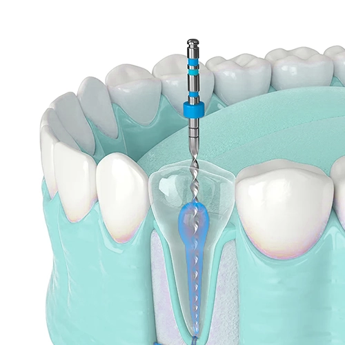 vemos cómo se hace tratamiento de endodoncia